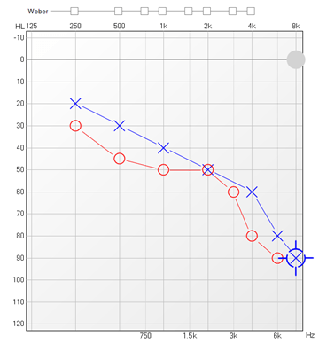 badanie słuchu wynik audiogram