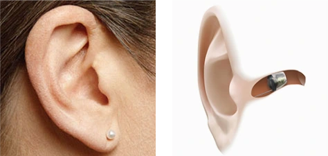 Najmniejsze aparaty słuchowe na świecie typu IIC, umieszczone w kanale słuchowym, są całkowicie niewidoczne dla innych ludzi.